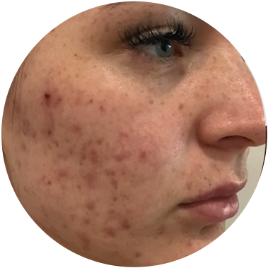 Pleť před použitím CICA EXO Solution Ampoule